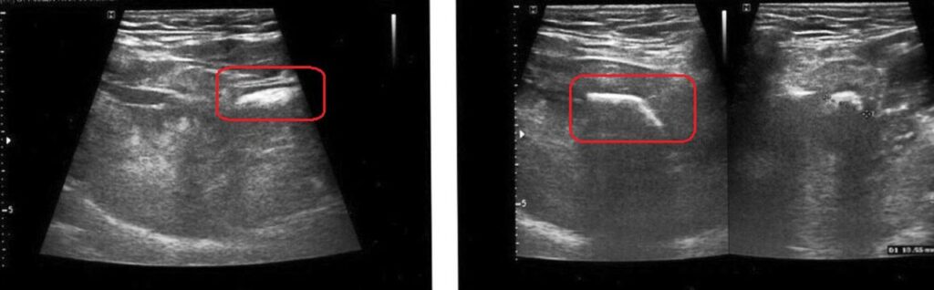 УЗИ , показывающее слюнный камень / ©BMJ Case Reports