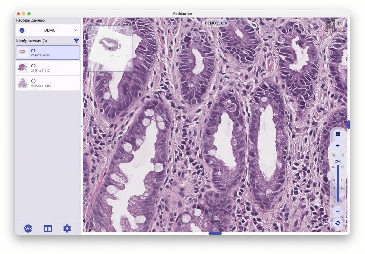 DEMO — коллекция демонстрационных полнослайдовых изображений различных новообразований пищеварительного тракта. Коллекция позволяет гостевому пользователю тестировать общий функционал приложения PathScribe. Скриншот программы предоставлен разработчиком А.В. Хвостиковым