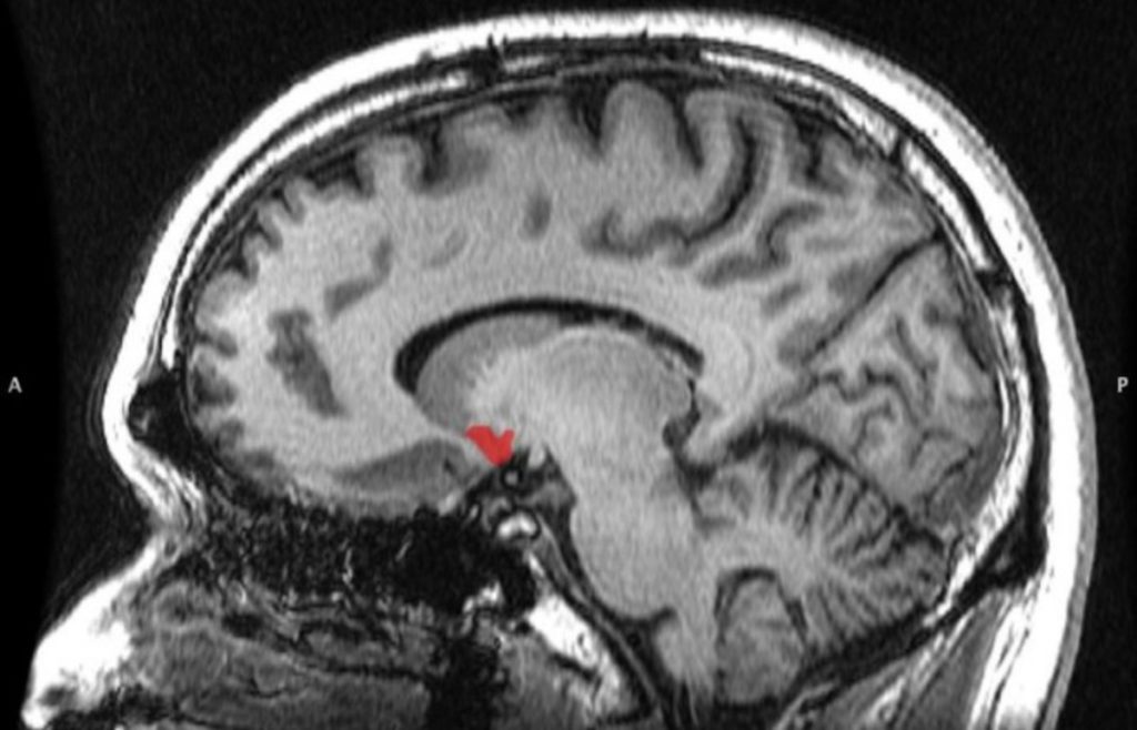 Местоположение прилежащего ядра на снимке головного мозга (отмечено красным цветом) / © Pacific Standard