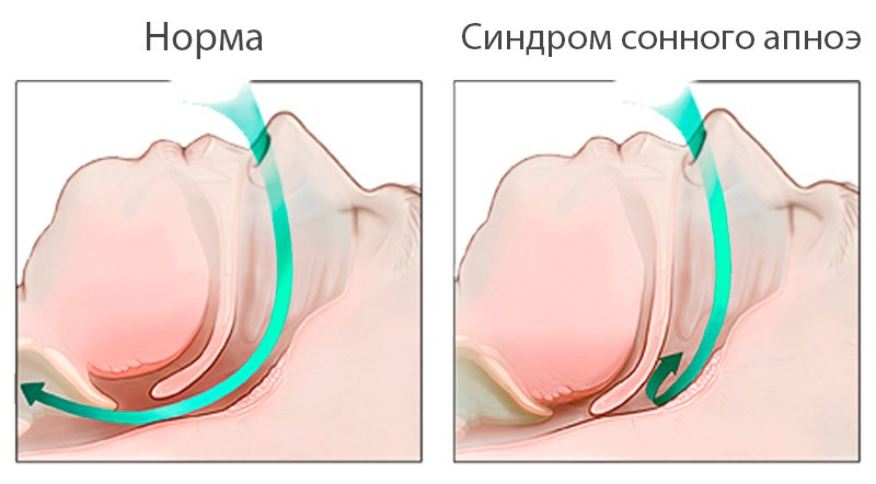 При сонном апноэ нарушается поступление кислорода в организм / © Полинтермед