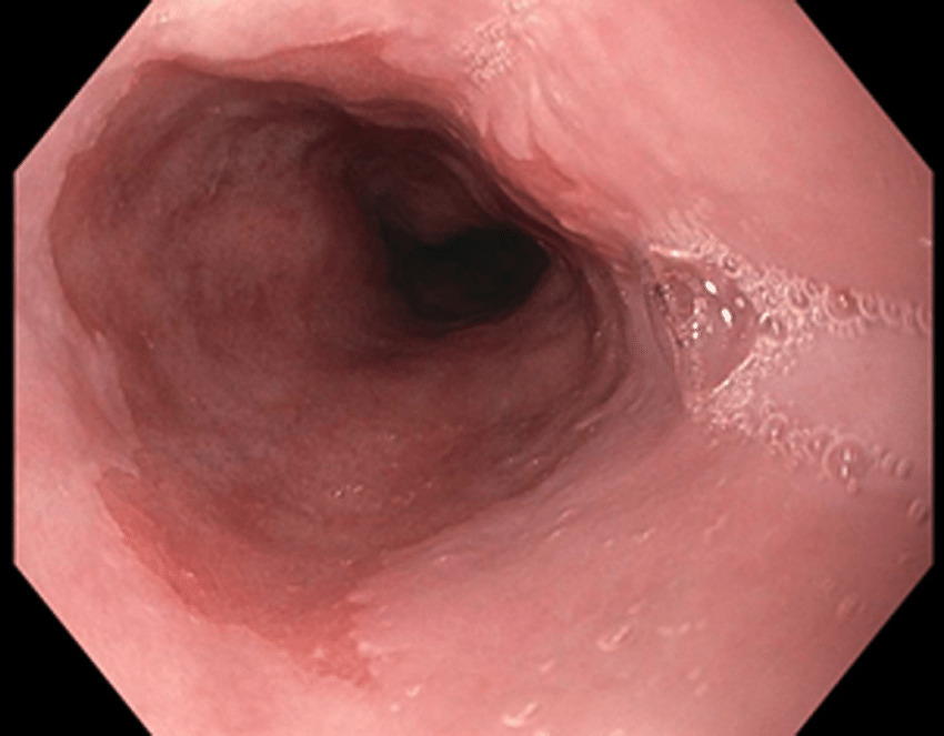 Фото пищевода пациента с синдромом Барретта, сделанное в процессе эндоскопии / © Steele et al., World Journal of Gastroenterology, 2019