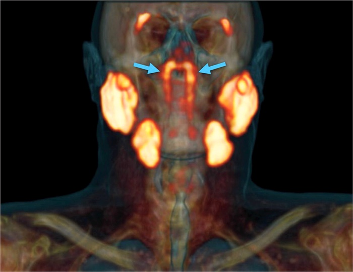 Трубные слюнные железы на ПЭТ-КТ / ©Valstar et al., 2020