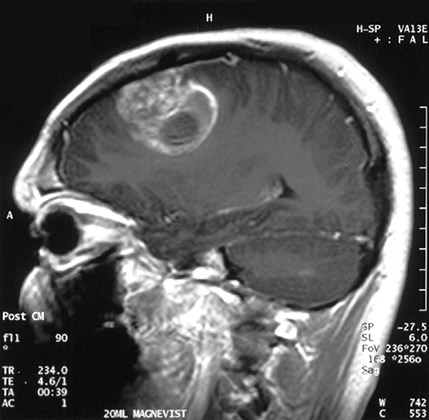 Глиобластома в человеческом мозге / © Kurzweil AI