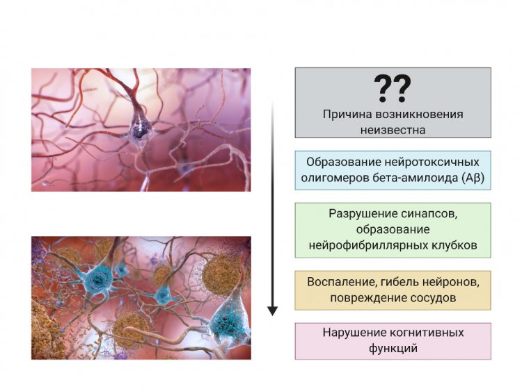 Этапы развития патологического процесса при болезни Альцгеймера. Автор: В.А. Митькевич. Предоставлено В.А. Митькевичем