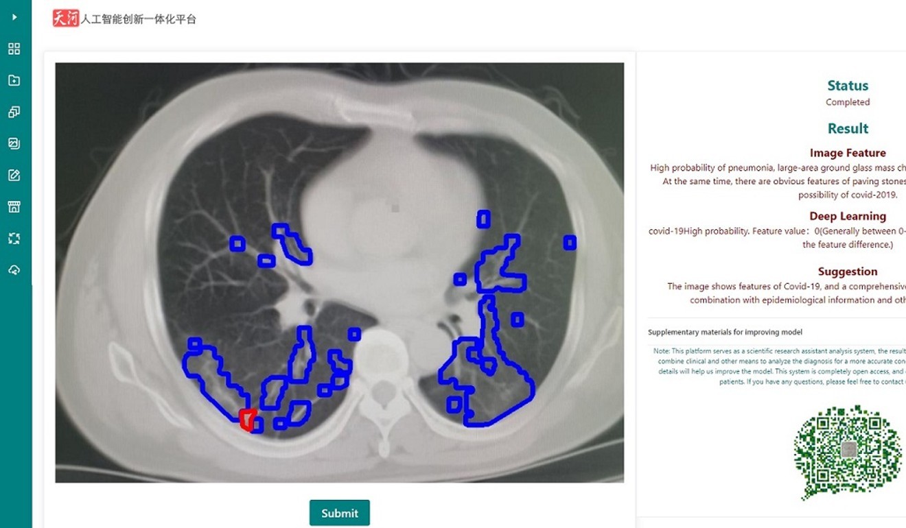 Covid-19: китайский суперкомпьютер использует искусственный интеллект для диагностики коронавирусной инфекции