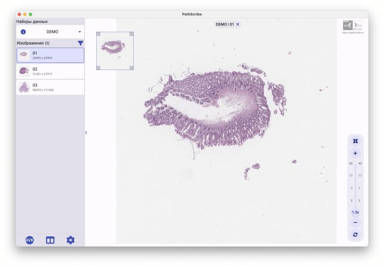 DEMO — коллекция демонстрационных полнослайдовых изображений различных новообразований пищеварительного тракта. Коллекция позволяет гостевому пользователю тестировать общий функционал приложения PathScribe. Скриншот программы предоставлен разработчиком А.В. Хвостиковым