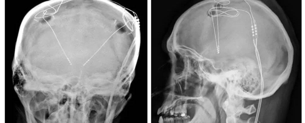 Рентгеновский снимок имплантированных электродов / ©Университет Западной Вирджинии