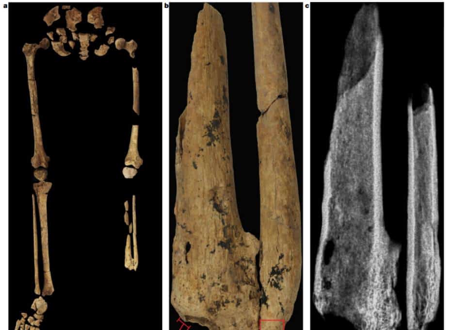 Сравнение костей правой и левой (частично ампутированной) ног древнего пациента / ©Tim Maloney et al.