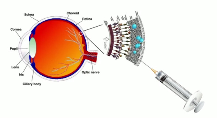 Принцип введения новой искусственной жидкой сетчатки / © IIT-Istituto Italiano di Tecnologia (М. Брамини) 
