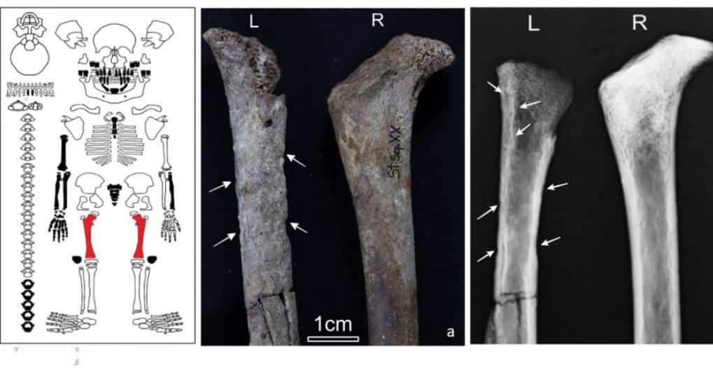 На схематичном изображении скелета показаны места повреждения костей / ©Rodrigo Oliveira et al.