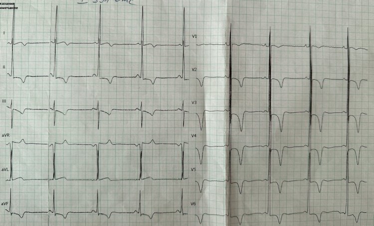 Признаки гипертрофии миокарда у пациента с гипертрофической кардиомиопатией (высокий вольтаж). Предоставлено Ю.Л. Лутохиной
