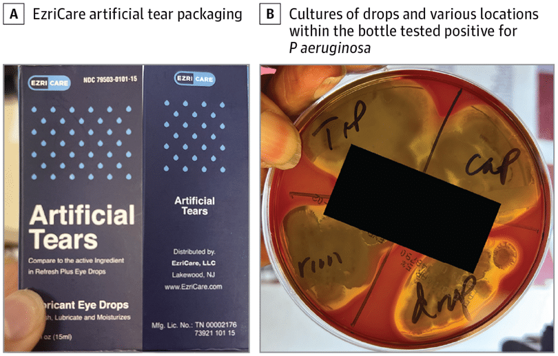 Капли EzriCare, а также крышку, ободок и кончик флакона подвергли культивированию. Все они оказались положительными на P. aeruginosa с множественной лекарственной устойчивостью / © JAMA Ophthalmology
