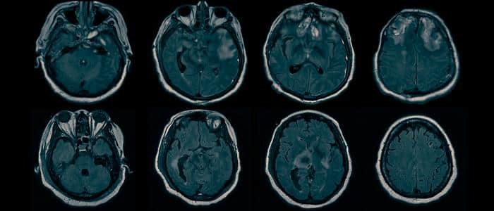 Механизмы развития скрытого сознания/ ©Columbia University Irving Medical Center