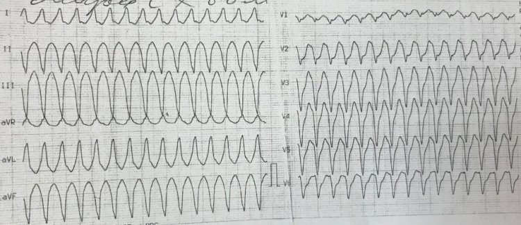 Желудочковая тахикардия у пациентки с аритмогенной кардиомиопатией правого желудочка. Предоставлено Ю.Л. Лутохиной