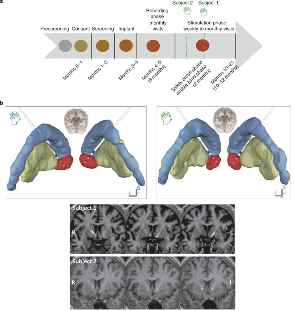 Поэтапная схема исследования (а). Трехмерная модель (восстановленная по томографии) погружения двух четырехполярных электродов к прилежащим ядрам, покрашенным в красный (b) / © Halpern С., et al., Nature Medicine, 2022