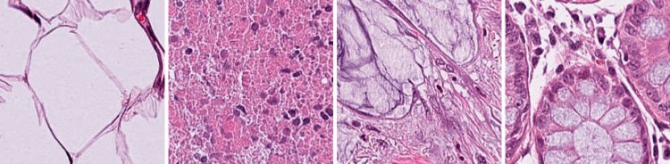 Набор NCT-CRC-HE-100K. Источник: Kather, J. N., Halama, N., and Marx, A. 100,000 histological images of human colorectal cancer and healthy tissue. 2018. Предоставлено В.Е. Карнауховым