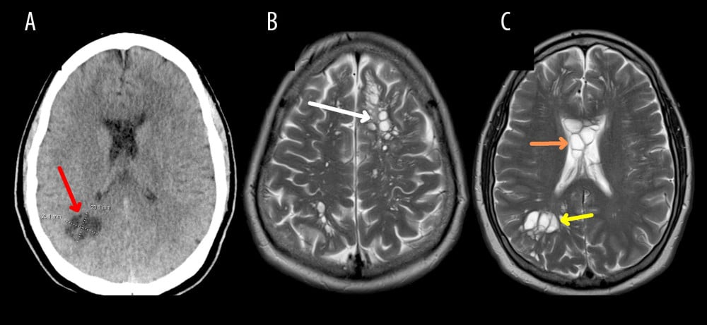 КТ-снимки мозга больного с пораженными участками / © 2024 American Journal of Case Reports, Eamonn Byrnes et al.