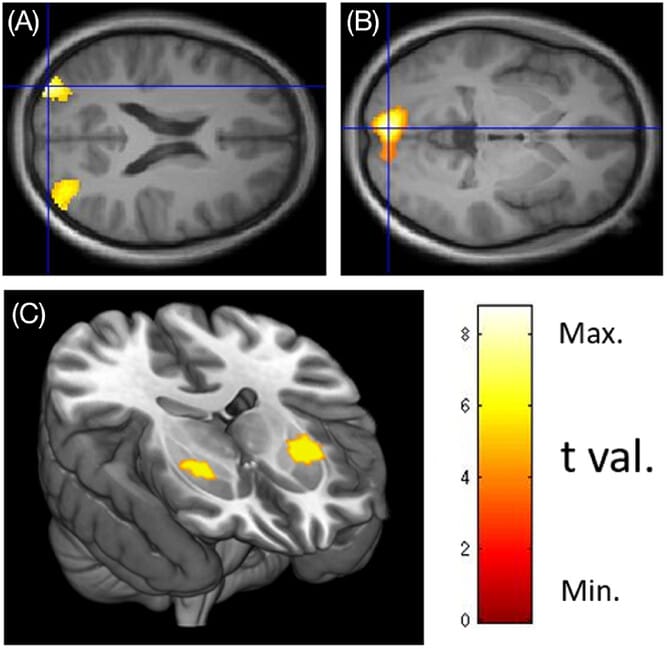 Снимки головного мозга, сделанные во время экспериментов / © Journal of Neuroimaging, Senal Peiris, Michael J. Tobia et al.