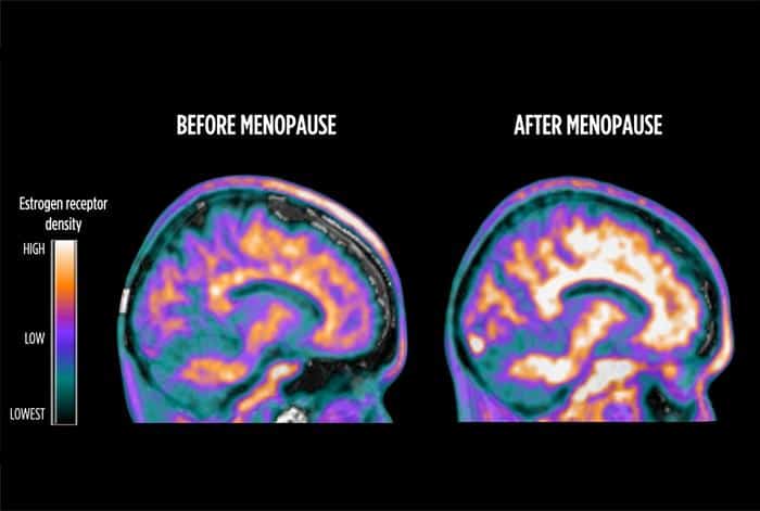 Мозг женщины до менопаузы (слева) и после. На снимках — плотность рецепторов эстрогенов растет по мере завершения менопаузы / © Mosconi Lab