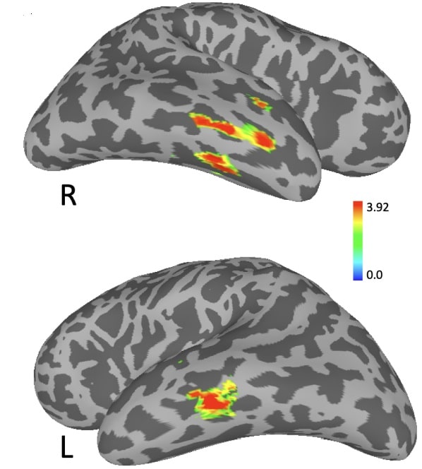 Активация срединной височной извилины на скане фМРТ / © John Andrew H. Chwe et al., JNeurosci, 2024